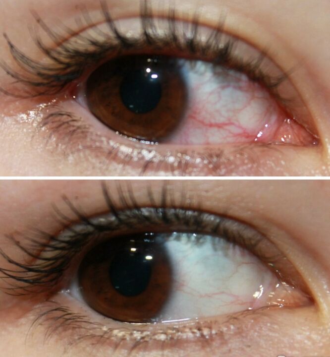 Ocuvit wirkt sehr schnell